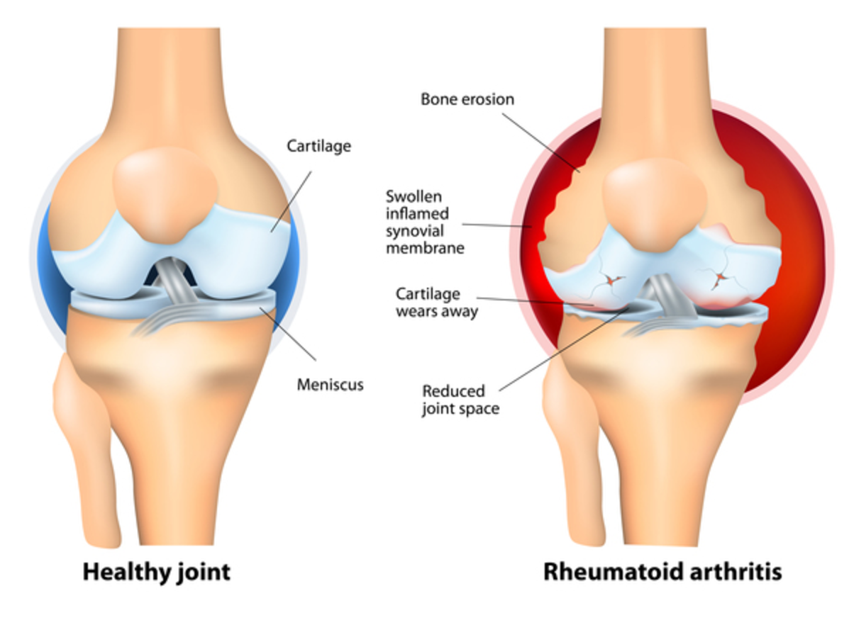 Cannabis for Arthritis